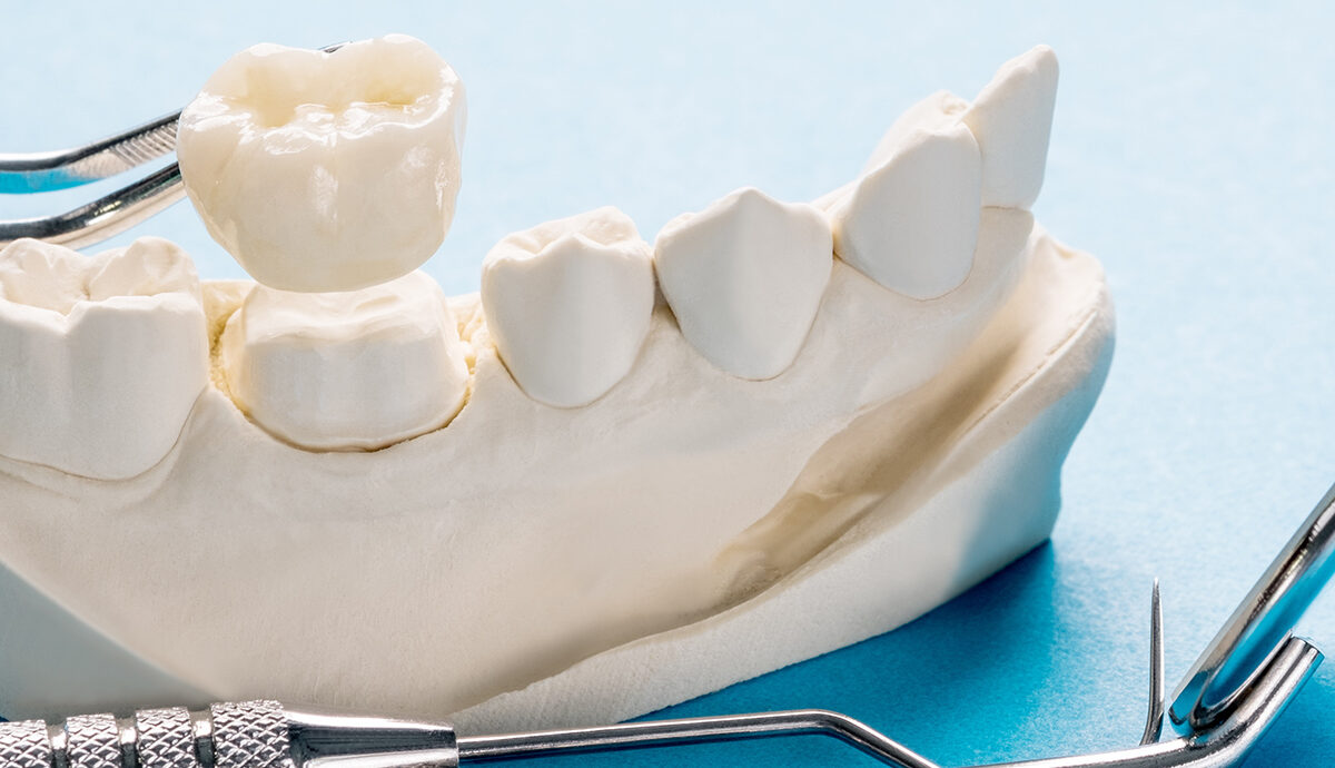 What Is a Dental Crown? Everything You Need to Know
