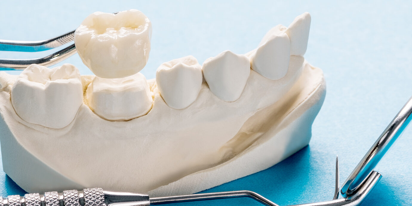 What Is a Dental Crown? Everything You Need to Know