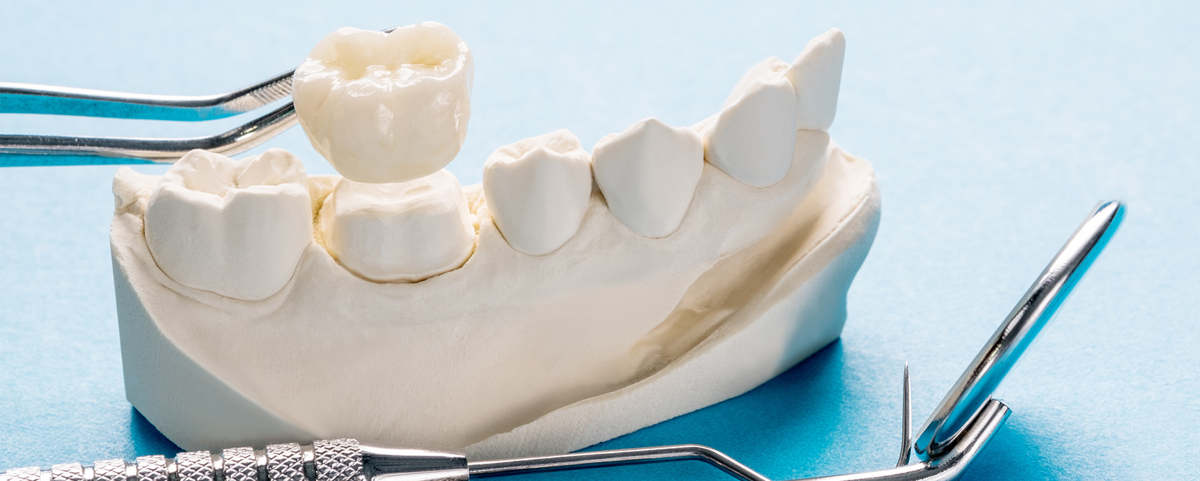 What Is a Dental Crown? Everything You Need to Know