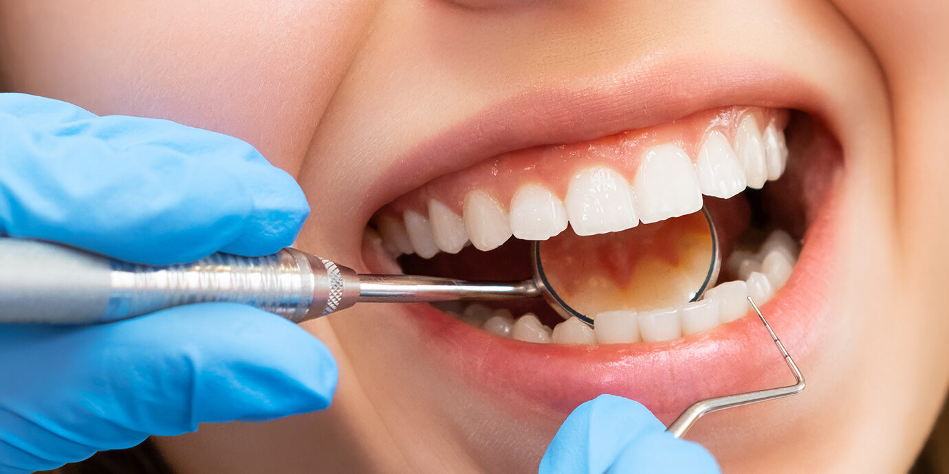 How Often Gum Disease Patients Should Visit the Dentist
