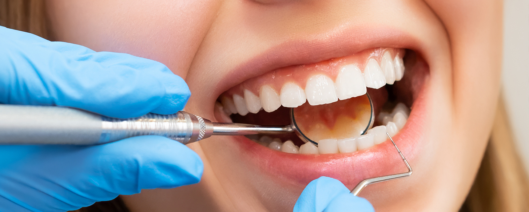How Often Gum Disease Patients Should Visit the Dentist